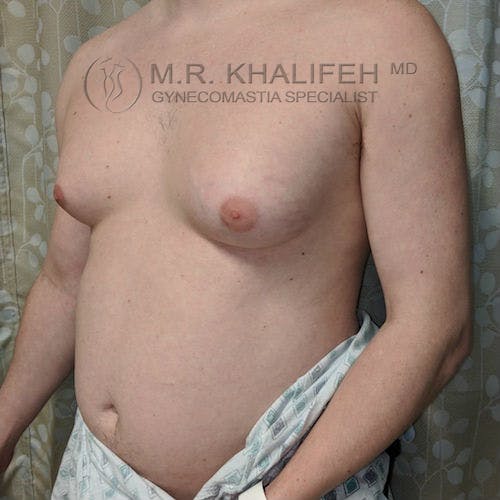 A person with gynecomastia stands partially draped in a medical gown, showing visible breast tissue on the chest. The background includes a patterned curtain and a medical logo watermark.