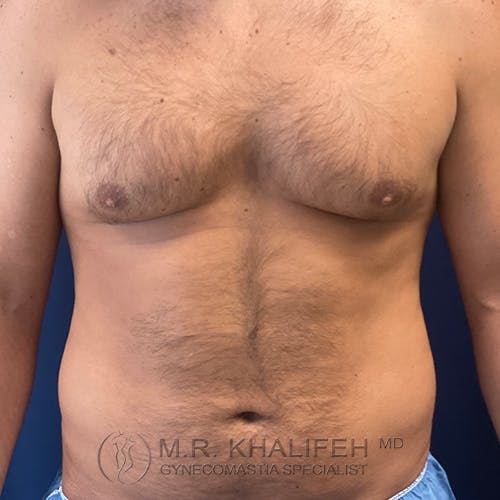 A shirtless adult male torso is shown from the front against a dark background, displaying moderately developed chest and abdominal hair.