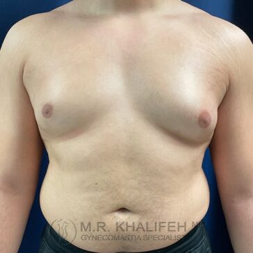 A person standing shirtless facing forward, showing an enlarged chest and abdomen against a plain, dark background.