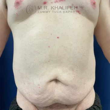 Bare abdomen of an adult with visible scars, loose skin, and red spots; upper torso and lower chest also visible against a blue background.
