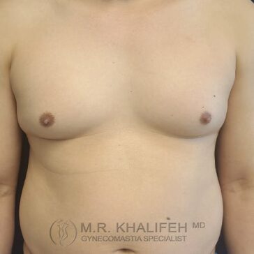 A person’s bare chest and torso exhibiting signs of gynecomastia. The image includes a watermark for a gynecomastia specialist.