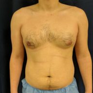 A shirtless adult with visible chest and abdominal hair stands against a dark background, wearing blue medical shorts.