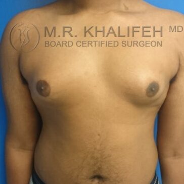 A person with a bare chest showing moderate gynecomastia, standing against a blue background with a surgeon's watermark visible.