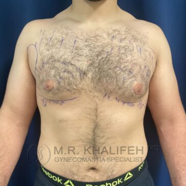 A male torso with chest markings, possibly pre-surgery, standing against a dark background. Text at the bottom reads "M.R. Khalifeh MD Gynecomastia Specialist.