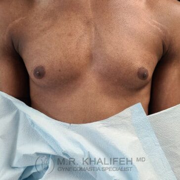 A person with visible gynecomastia is shown from the shoulders to the abdomen, draped with a blue medical sheet. The logo "M.R. Khalifeh MD Gynecomastia Specialist" appears at the bottom.