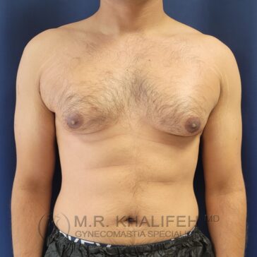 A person with visible gynecomastia, characterized by enlarged breast tissue, stands against a blue background. The lower part of their face is not visible.
