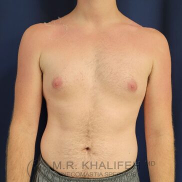 A shirtless person with asymmetric sunburns on both shoulders and upper chest, standing against a dark background.