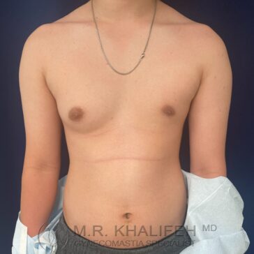 A person with mild gynecomastia stands facing forward, showing a bare chest and abdomen, with a silver necklace and draped medical gown on one arm. Text at bottom reads "M.R. Khalifeh MD, Gynecomastia Specialist.