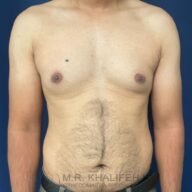 A shirtless adult male with visible gynecomastia, standing against a plain blue background. The image is focused on the chest and upper abdomen.