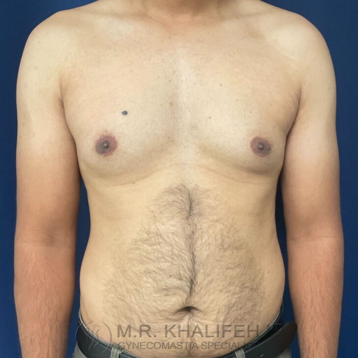 A shirtless adult male with visible gynecomastia, standing against a plain blue background. The image is focused on the chest and upper abdomen.
