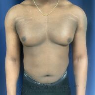 A person with visible gynecomastia stands facing forward against a blue background, wearing a gold necklace and black Calvin Klein underwear.