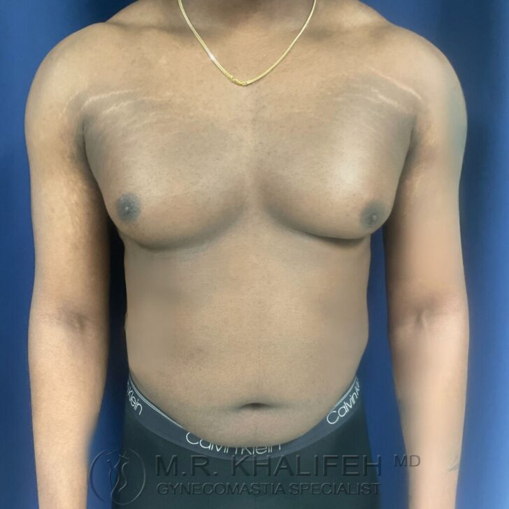 A person with visible gynecomastia stands facing forward against a blue background, wearing a gold necklace and black Calvin Klein underwear.