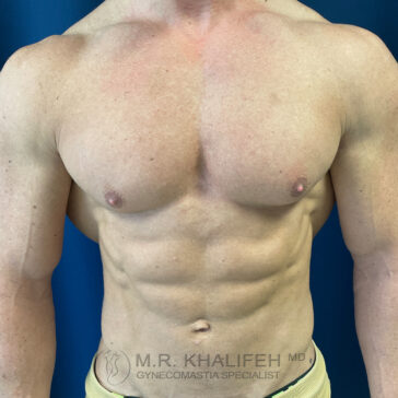 A shirtless male torso with defined chest and abdominal muscles, standing against a blue background. The watermark reads "M.R. Khalifeh MD Gynecomastia Specialist.