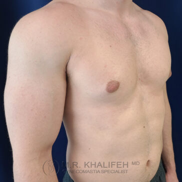 Adult male torso shown from the side, topless, with a slightly raised right arm, against a dark blue background. Text at the bottom reads "M.R. Khalifeh MD Gynecomastia Specialist.