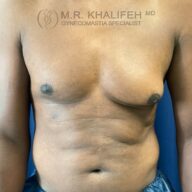 A person’s bare chest and abdomen are shown against a blue background, displaying visible gynecomastia. The upper text reads, "M.R. Khalifeh MD, Gynecomastia Specialist.
