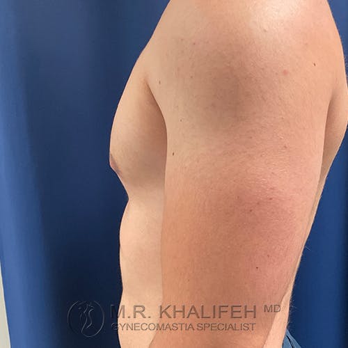 A side view of a person's bare upper torso and arm in front of a blue background, with a watermark reading "M.R. Khalifeh MD, Gynecomastia Specialist.
