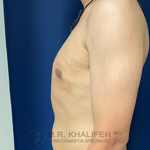 Side view of a shirtless person with a flat chest, standing against a blue background. The image includes a watermark for a gynecomastia specialist.