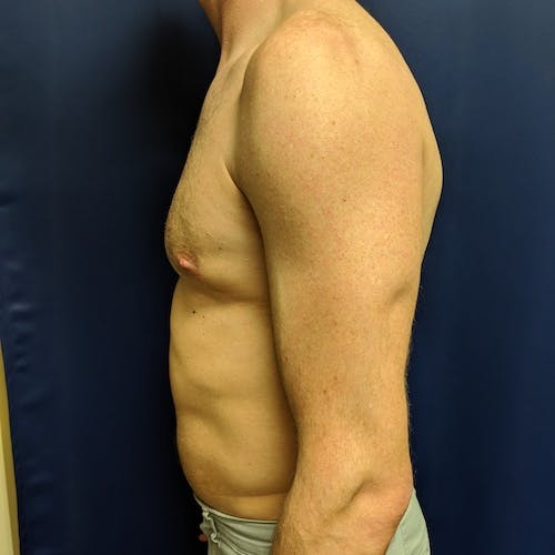 A shirtless adult male stands in profile against a dark blue background, showing his upper body, arm, and partial abdomen.
