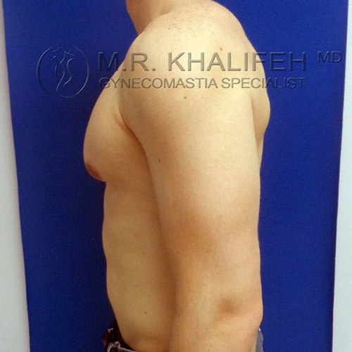 A shirtless person standing sideways against a blue background, showing a visible enlargement of breast tissue on the chest.