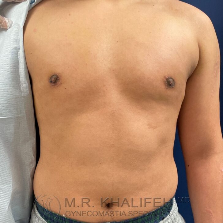 A shirtless person stands against a blue background, displaying a flat chest with visible nipples. Text at the bottom reads "M.R. Khalifeh MD Gynecomastia Specialist.