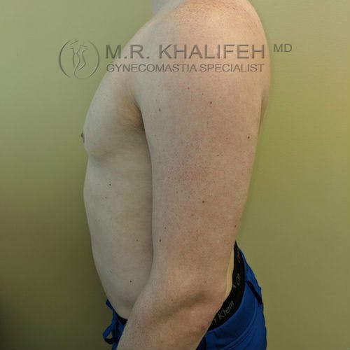 Side view of a shirtless male torso against a light green background, displaying the chest and abdomen for medical documentation.