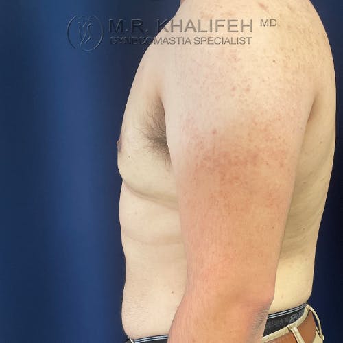 A man is shown from the side with visible gynecomastia, standing shirtless against a dark blue background. The logo "M.R. Khalifeh MD Gynecomastia Specialist" is at the top of the image.