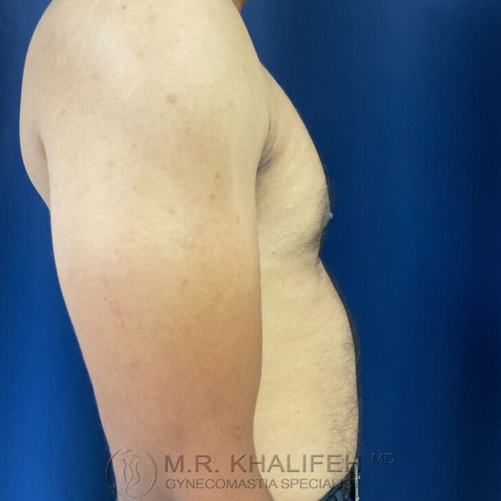 A shirtless man is shown from the side against a blue background, displaying a slightly enlarged chest area.