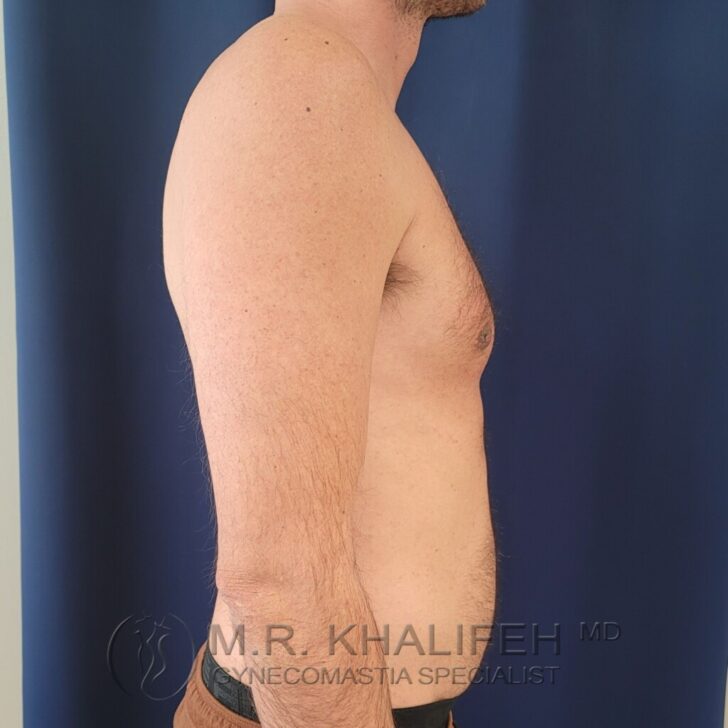 A shirtless man stands in profile against a dark blue background, displaying his upper body and chest. Text at the bottom reads "M.R. Khalifeh MD Gynecomastia Specialist.