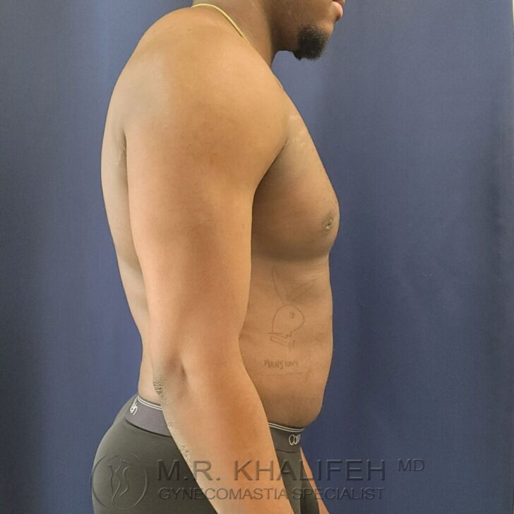 A man stands in profile against a dark blue background, wearing dark underwear. A faint tattoo is visible on his left side. Logo text at bottom reads “M.R. Khalifeh MD Gynecomastia Specialist.”.