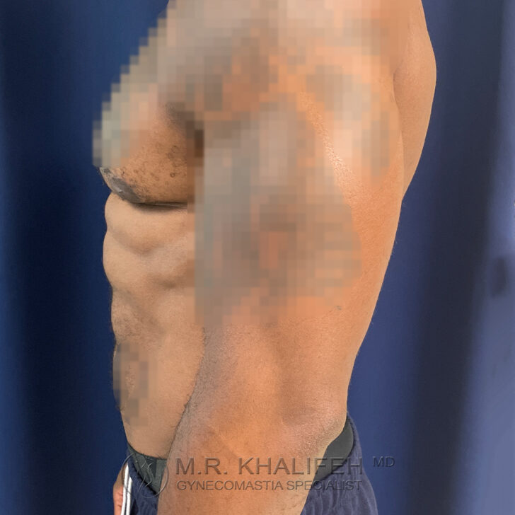 Side view of a shirtless male torso showing defined abdominal muscles and slight chest protrusion, against a dark background.