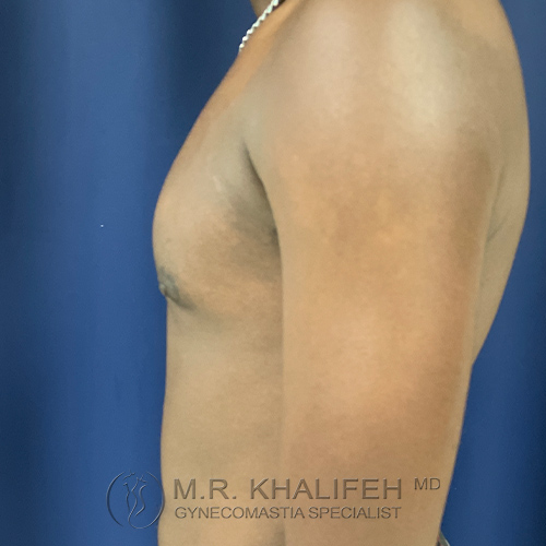 Side view of a bare-chested person standing against a blue background, showing the chest and arm. Text reads "M.R. Khalifeh MD Gynecomastia Specialist.