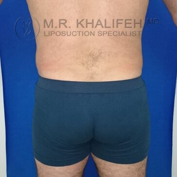 A person standing with their back to the camera, wearing dark shorts, in front of a blue background. The image features a watermark for a liposuction specialist.
