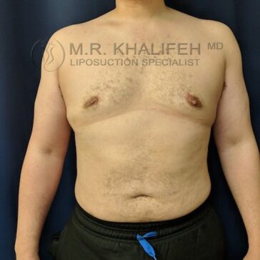A shirtless person stands against a dark background, showing a flat chest and visible scars. The text overlay reads "M.R. Khalifeh MD Liposuction Specialist.