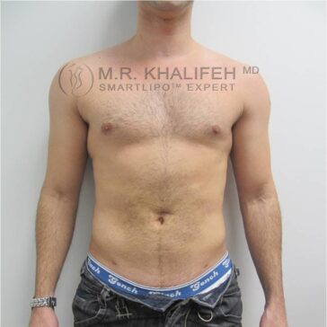 Shirtless adult male standing against a plain wall, facing forward, with hands in pockets. Visible branding watermark from a cosmetic surgery expert.