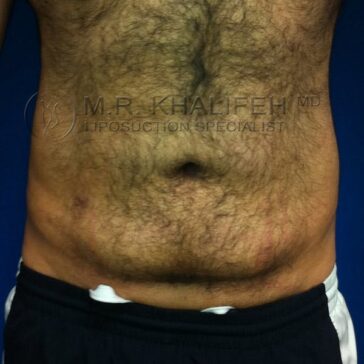 Close-up of a man's abdomen showing body hair, minor scarring, and skin irregularities, with part of black shorts visible at the bottom.