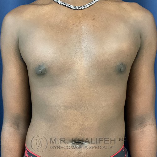 A person’s bare chest showing mild breast tissue enlargement and prominent nipples against a blue background.