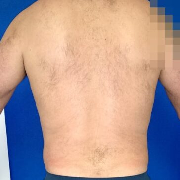 A person’s bare back facing the camera against a blue background; the right upper arm is pixelated for privacy.