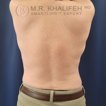 A person’s bare back is shown facing the camera against a dark background, with khaki pants and a brown belt visible. The image has a watermark for M.R. Khalifeh MD, Smartlipo Expert.
