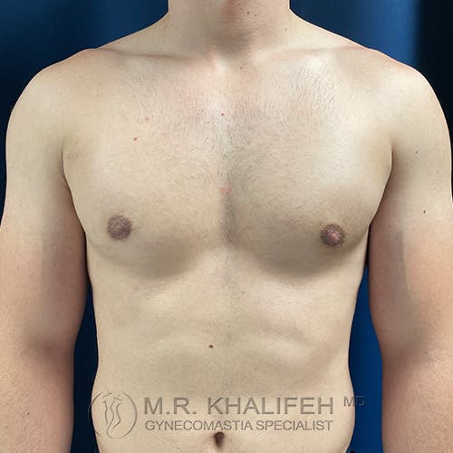 A shirtless person standing against a blue background, showing their chest and upper torso. The image includes a watermark for M.R. Khalifeh, MD, Gynecomastia Specialist.