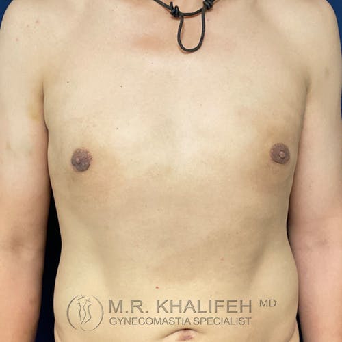 A person's bare chest and upper abdomen, showing a circular necklace and logo text reading “M.R. Khalifeh MD, Gynecomastia Specialist” at the bottom.