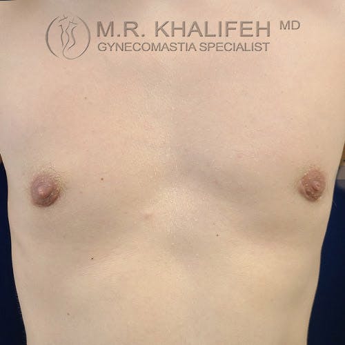Bare chest of a person with visible gynecomastia, displaying enlarged breast tissue beneath both nipples. Text at the top reads "M.R. Khalifeh MD Gynecomastia Specialist.