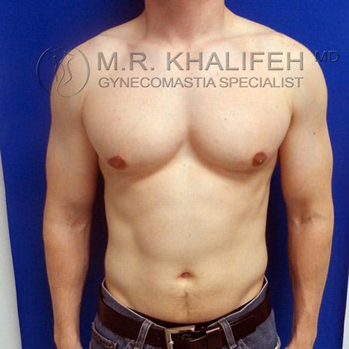 A shirtless man stands against a blue background, showing prominent breast tissue on his chest. Text on the image reads "M.R. Khalifeh MD, Gynecomastia Specialist.