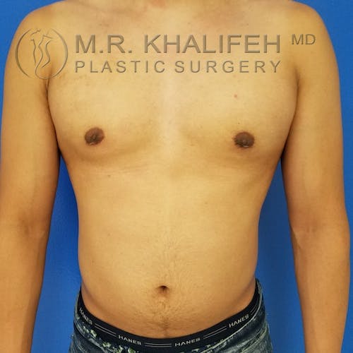 A shirtless person stands against a blue background, showing their chest and abdomen. The image includes the logo and text for M.R. Khalifeh, MD, Plastic Surgery.