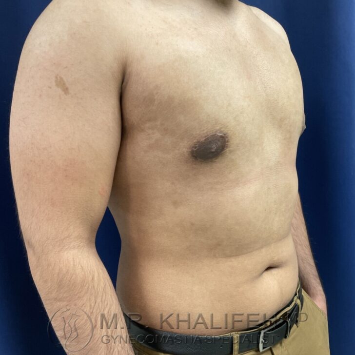 A shirtless man with a slightly visible scar on his left chest area, standing sideways against a dark blue background.