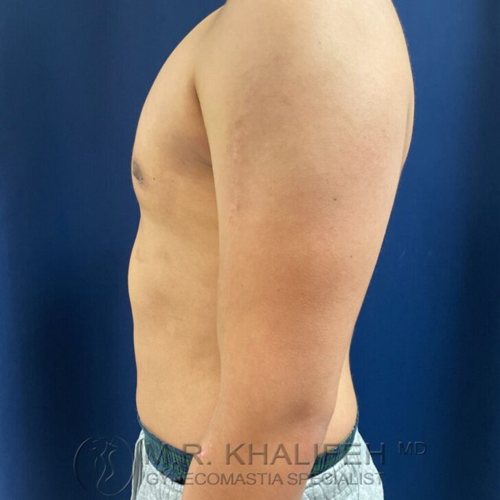 Side view of a shirtless person standing against a blue background, showing the upper body, arm, and torso.