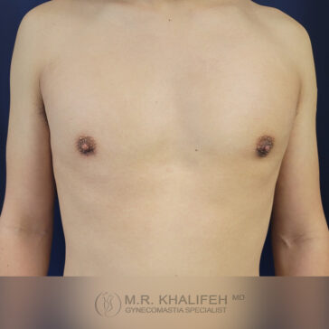 A person’s bare chest is shown against a plain background, displaying a flat and even contour. The lower portion includes a watermark with text and a logo.