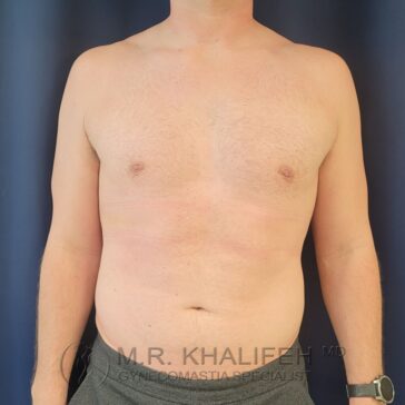 Shirtless adult male standing against a plain dark background, showing chest and abdomen. Text watermark at bottom reads "M. R. Khalifeh MD, Gynecomastia Specialist.