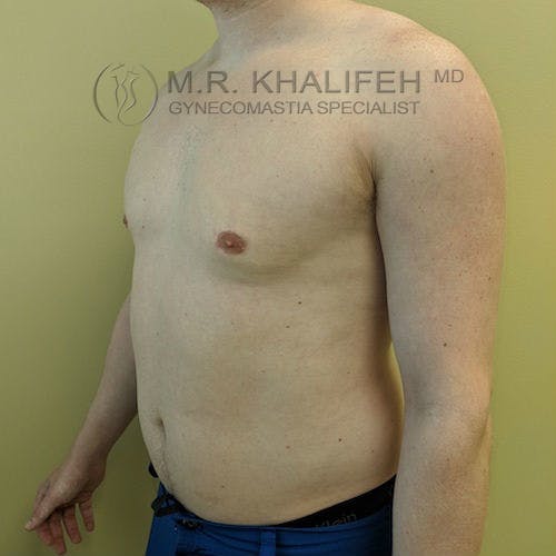 A shirtless adult male is shown from the side and front, standing against a plain light green background. The image has a watermark for a gynecomastia specialist.