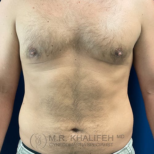 A close-up view of a man's bare chest and abdomen, showing mild gynecomastia, against a blue background. The watermark reads "M.R. Khalifeh MD Gynecomastia Specialist.