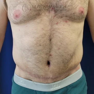 A shirtless male torso with visible surgical scars around the lower abdomen and some redness on the chest and abdomen.